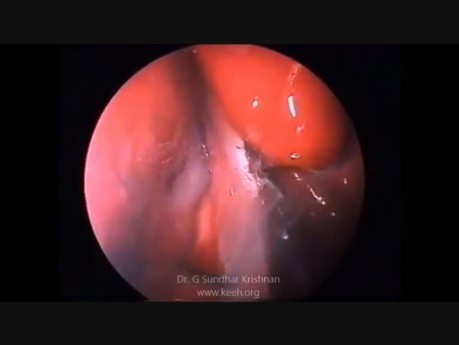 Extirpación endoscópica de fibroma juvenil 