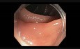 Canal de colonoscopia - cómo encontrar una lesión plana sutil
