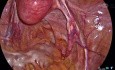 Histerectomía laparoscópica total: disección retroperitoneal explicada por el Dr. Kunal Rathod