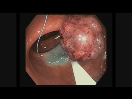 Polipectomía endoloop