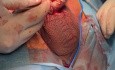 Sutura en el tubo del implante de prótesis de pene