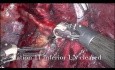 Lobectomía robótica de un tumor del bronquio basal del lóbulo inferior derecho