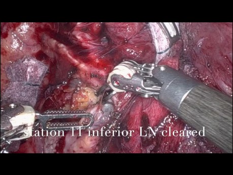 Lobectomía robótica de un tumor del bronquio basal del lóbulo inferior derecho