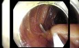 Lesión colónica submucosa intraluminal