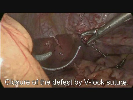 Cirugía laparoscópica de una hernia diafragmática 