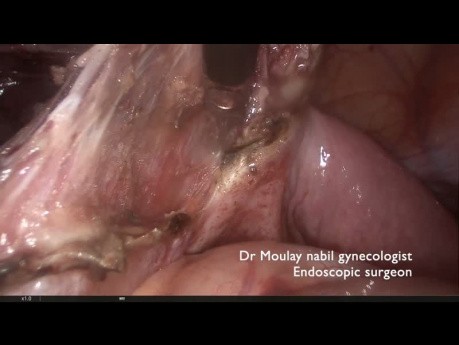 Hemihisterectomía en un caso del útero bicorne