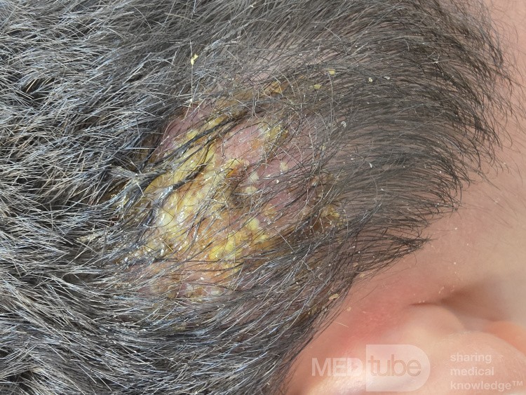 Querión (infección por tiña de la cabeza)