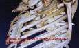 Reconstrucción de la pared torácica para tórax inestable