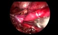 Ureteropyeloplastía laparoscópica transperitoneal de uréter retrocavo
