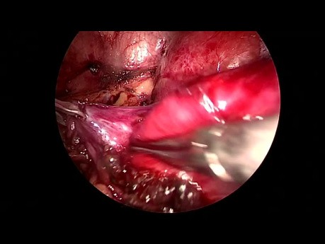 Ureteropyeloplastía laparoscópica transperitoneal de uréter retrocavo