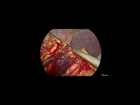 Hemicolectomía radical derecha laparoscópica con escisión mesocólica