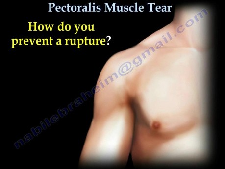 Músculo pectoral - desgarro del tendón