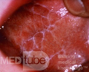 Liquen plano (no erosivo, mucosa bucal)
