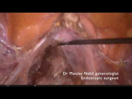 Sacrocolpopexia estándar para el prolapso urogenital