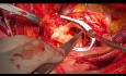 Paciente con Aneurisma de 20cm en la Aorta Ascendente