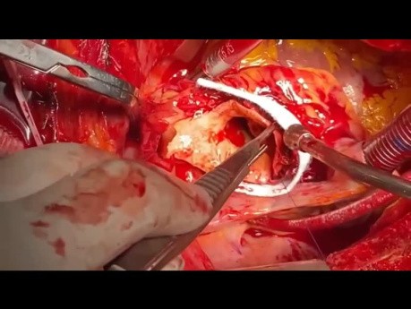 Paciente con Aneurisma de 20cm en la Aorta Ascendente