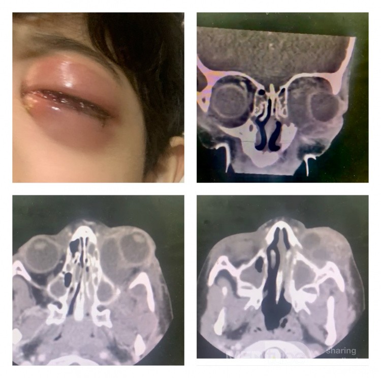 Sinusitis aguda complicada con absceso orbitario izquierdo