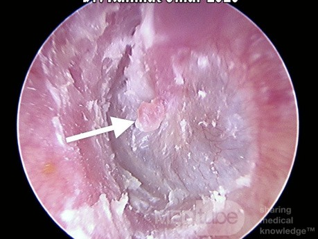 Queratinosis del canal auditivo con pólipo de Umbo