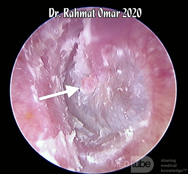 Queratinosis del canal auditivo con pólipo de Umbo