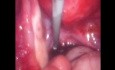 Endometrioma Cistectomia Con Ayuda de Sonda de Foley
