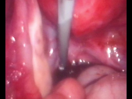 Endometrioma Cistectomia Con Ayuda de Sonda de Foley