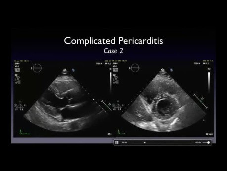 Pericarditis complicada - definición y detección del pericardio anormal