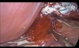 Miotomía laparoscópica de Heller y fundoplicatura DOR después de una dilatación con balón fallida