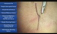 Hacer un nudo con instrumentos - técnicas de sutura