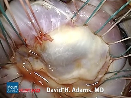 Reparación de la válvula mitral por prolapso del velo posterior