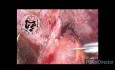 Exploración y anastomosis laparoscópica del CBC después de una CPRE fallida