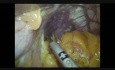 Gastrectomía laparoscópica de manga de tres trocares