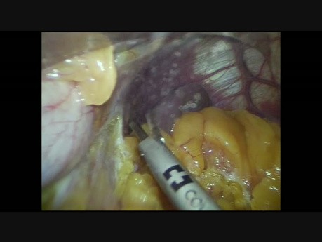 Gastrectomía laparoscópica de manga de tres trocares