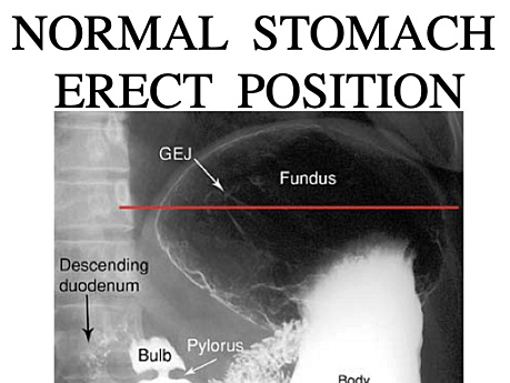 Cirugía radiológica - enfermedades de estómago y duodeno