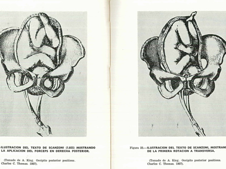 Occipito Posteriores Agüero