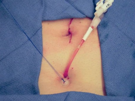 Colocación suprapúbica del cath durante una prostatectomía radical robótica