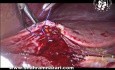 Control de los sinusoides del lecho sangrante de la vesícula biliar