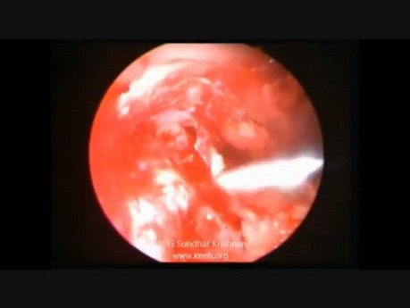 Manejo endoscópico del hongo cerebral