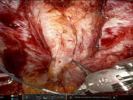 Reparación robótica transabdominal de abajo hacia arriba con R-PeTEP IIP DR y tumorectomía umbilical