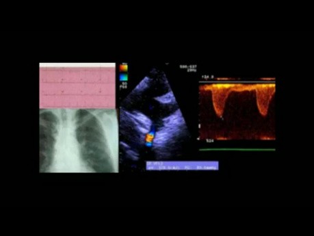 Un caso de Coartación de la Aorta - ECG, Ecocardiograma y Tratamiento