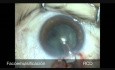 Facotrabeculectomía de un puerto en queratotomía radial en paciente con glaucoma