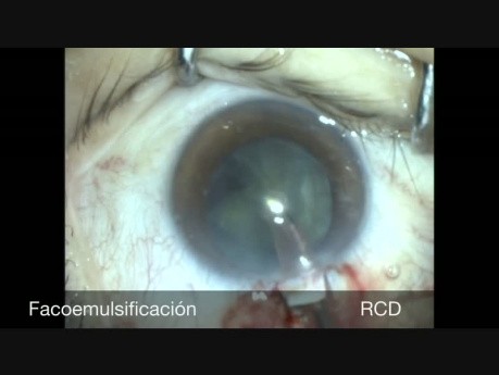 Facotrabeculectomía de un puerto en queratotomía radial en paciente con glaucoma
