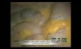 Hemicolectomía derecha laparoscópica