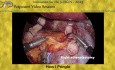 Extirpación laparoscópica de paraganglioma retrocavo con técnica de colgamiento de la vena cava inferior