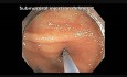 Colonoscopia - lesión plana sutil revelada como pólipo serrado
