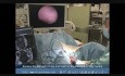 Resección histeroscópica de mioma cervical