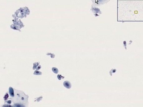 Atrofia del cuello uterino - histopatología