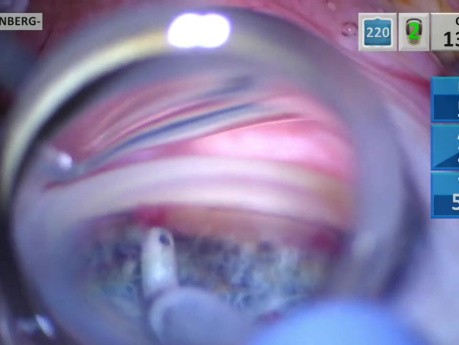 Mejora de la técnica de inyección de Microstent para glaucoma
