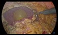 Resección anterior laparoscópica con resección parcial en bloque de la vejiga urinaria