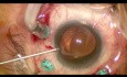 Subluxación de la LIO de una pieza - captación óptica de la rexis capsular anterior