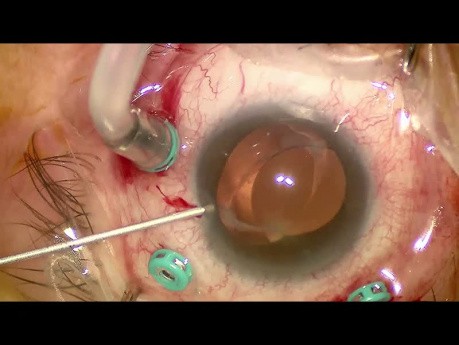 Subluxación de la LIO de una pieza - captación óptica de la rexis capsular anterior